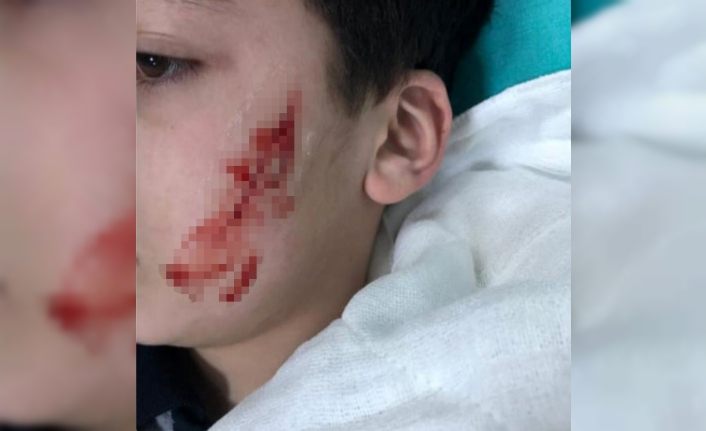 6. sınıf öğrencisi kalemtıraş bıçağıyla arkadaşının yüzünü kesti