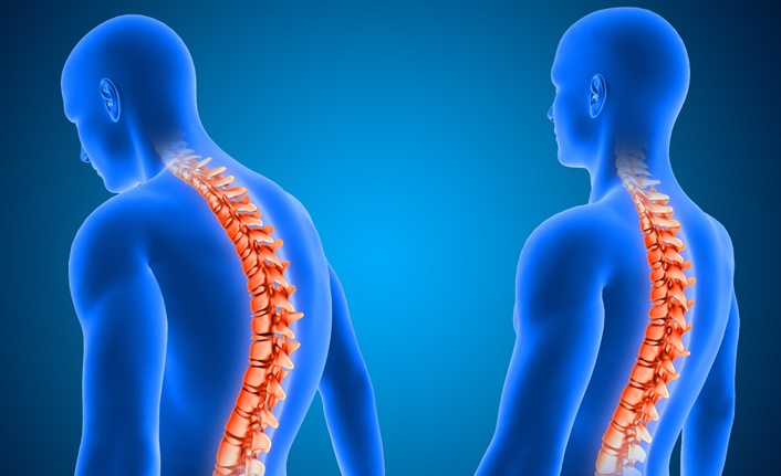 Skolyozun görülme sıklığının kadınlarda erkeklere oranla 10 kat daha fazla