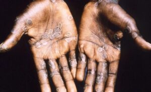 Dünya Sağlık Örgütü’nün (DSÖ) “acil durum” ilanı sonrası ” Türkiye’de