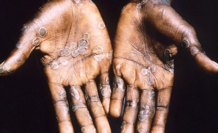 Dünya Sağlık Örgütü’nün (DSÖ) “acil durum” ilanı sonrası ” Türkiye’de